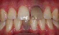 چه عواملی باعث سیاه شدن دندان می‌شوند؟